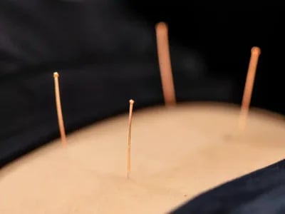 Az akupunktura története az ókortól napjainkig – Akupunkturbehandlungen usw