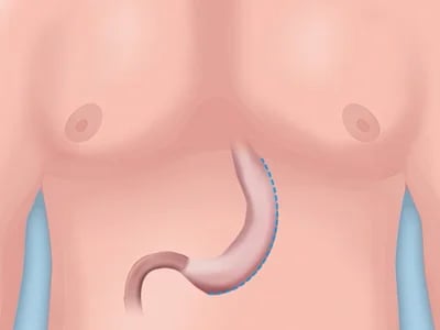 Warum die Magenverkleinerung Türkei Beste Klinik internationale Patienten anzieht